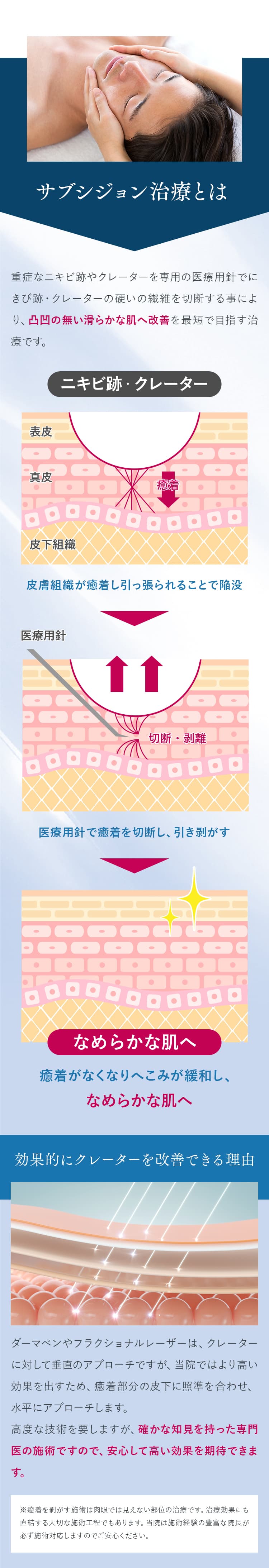 サブシジョン治療とは